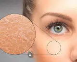 Gros plan sur un œil et une partie du visage d'une femme, avec un zoom montrant la **peau sèche du visage** craquelée et une autre zone plus lisse.