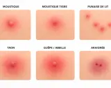Comparaison de six types de piqûres : moustique, moustique tigre, punaise de lit, taon, guêpe/abeille et araignée. Chaque image montre un différent bouton sur la peau.
