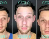 Nieudany botoks czoła? Jak szybko naprawić powikłania!