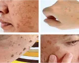 Gros plan sur des taches brunes sur la peau, dont un lentigo solaire sur le visage et le dos de la main.