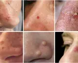 Divers types de lésions cutanées sur le nez, dont un bouton dans le nez douloureux que faire.