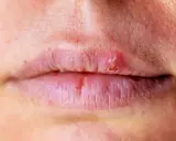 Labbra secche e screpolate, con piccole lesioni. Potrebbe essere un segnale che il fegato ha bisogno di attenzione.