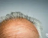 Gros plan sur le front d'un homme aux cheveux gris clairsemés. La vitamine D, source de bienfaits pour les cheveux, est essentielle pour leur santé.