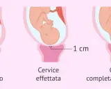 Illustrazione del travaglio: cervice non dilatata, dilatata di 1 cm e completamente dilatata (10 cm). Il cerchiaggio cervicale è una procedura per sostenere una cervice debole.