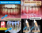 Zaniedbane dziąsła i kość to paradontoza. Leczenie recesji dziąseł i odbudowa kości to klucz do ratowania zębów.