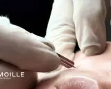 Gants blancs et outil fin pour l'extraction de gros points noirs sur le nez. Soin esthétique précis.