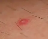 Widoczny czerwony pryszcz z białym czubkiem i włoskiem, objaw zapalenia mieszka włosowego.