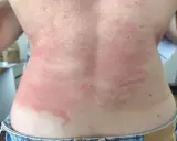 Le dos présente des rougeurs et des plaques, signe d'une réaction cutanée. Il est urgent de trouver une solution pour calmer les démangeaisons.
