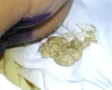 Feci grasse e giallastre, indicative di steatorrea, su un pannolino. Le cause possono essere molteplici.