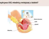 Ilustracja pokazuje, jak wygląda macica podczas badania USG. Widoczne są pęcherz moczowy, jajnik, jajowód i odbytnica.
