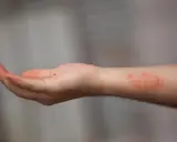 Poignet présentant une dartre cutanée rouge et irritée.