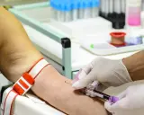 Wysokie żelazo w surowicy? Zrozum wyniki i chroń zdrowie