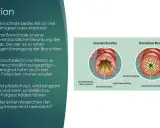 Vergleich gesunder und entzündeter Bronchien. Bei Asthma kommt es zu Muskelverkrampfungen und Schwellungen, die die Atemwege verengen.