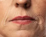 Primo piano del volto di una donna con linee tratteggiate che indicano le aree interessate da rughe naso labiali, suggerendo come eliminare le rughe naso labiali.