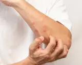Un bras couvert de boutons rouges, la personne se gratte pour savoir comment ne pas se gratter les boutons de moustiques.