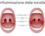 Illustrazione che mostra un'infiammazione delle tonsille, comune nel mal di gola dei bambini. Le tonsille gonfie e rosse sono visibili.