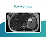 Przekrój tomografii komputerowej wątroby z widocznym guzem.