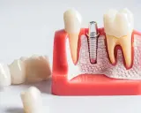 Ból po wyrwaniu ósemki: Ile trwa, co jest normą i kiedy do dentysty?