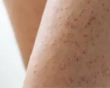 Gros plan sur une peau présentant des petites bosses rouges, typiques de la kératose pilaire.
