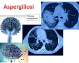 Aspergillosi: immagini di Aspergillus e TAC polmonari che mostrano un aspergilloma. L'aspergillosi è contagiosa.