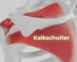 Kalkschulter: Ablagerungen im Schultergelenk. Was tun? Hier wird die Ursache der Schmerzen visualisiert.