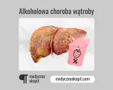 Chora wątroba i woreczek z napisem "%" sugerują, czy alkoholowe zapalenie wątroby jest wyleczalne.