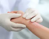 Mains gantées examinant une éruption cutanée rouge sur un poignet, suggérant un traitement eczema.
