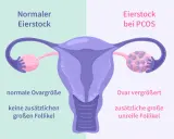 Porównanie jajnika: normalny jajnik z małą ilością pęcherzyków i jajnik przy PCOS z licznymi, niedojrzałymi pęcherzykami, co jest jednym z objawów PCOS.