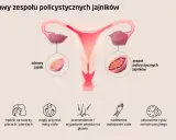 PCOS: Co to jest? Objawy, leczenie i życie z Zespołem Policystycznych Jajników