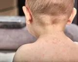 Skóra dziecka pokryta drobnymi, czerwonymi krostkami. To typowa wysypka po trzydniówce, która pojawia się po ustąpieniu gorączki.