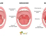 Ilustracja porównująca zdrowe gardło z gardłem w anginie wirusowej i bakteryjnej.