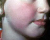 Barnets kinder är röda, vilket kan vara ett tecken på hjärnhinneinflammation. Utslagen är diffusa och rodnande.