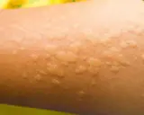 Pelle di bambino con pomfi rossastri e gonfi, tipici dell'orticaria.