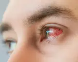 Silnie zaczerwienione oko, objaw choroby zwanej potocznie "pink eye" po polsku. Widoczne naczynka i łzawienie.