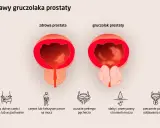 Ilustracja porównuje zdrową prostatę z gruczolakiem, pokazując objawy takie jak ból, częste parcie na mocz i słaby strumień. Leczenie farmakologiczne jest kluczowe.