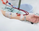 Ramię pacjenta z założonym cewnikiem Sheldona, podłączonym do aparatury dializacyjnej.