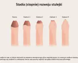 Ilustracja pokazuje, jak wygląda penis w różnych stadiach stulejki, od normy do stadium 4.