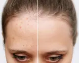 Avant/après : peau acnéique transformée en peau nette. Découvrez par quoi remplacer l'acide salicylique pour une peau parfaite.