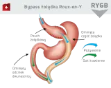 Schemat bajpas żołądka Roux-en-Y. Pokazuje, jak pokarm i soki trawienne omijają część żołądka i dwunastnicy.