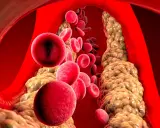 Wysoki cholesterol: Czy masz te objawy? Sprawdź, zanim będzie za późno.