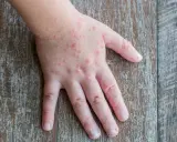 Mani di bambini con eruzioni cutanee rosse, simili a quelle che a volte compaiono su bocca e piedi.