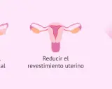 Ilustración de métodos anticonceptivos: espesa el moco cervical, reduce el revestimiento uterino e impide la ovulación. El diu en España es una opción.