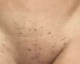 Peau présentant des boutons après rasage, avec des rougeurs et de petites imperfections.