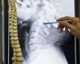 Un medico indica una radiografia della colonna vertebrale cervicale, evidenziando possibili metastasi ossee.