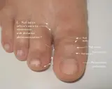 Gros orteil avec ongle incarné. Le prix d'une consultation podologue pour ce problème est indiqué.