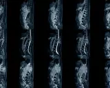 Obrazy MRI kręgosłupa ukazujące chorobę zwyrodnieniową. Widoczne zmiany mogą wpływać na stopień niepełnosprawności.