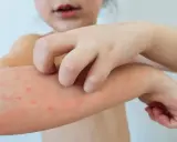 Dziecko drapie swędzące krostki na ramieniu, objawy ospy u dzieci.