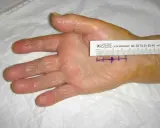Main de patiente avec marques violettes et règle millimétrée, indiquant la zone d'intervention pour un syndrome du canal carpien.