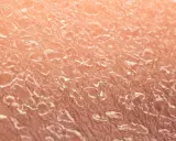 Szorstka skóra u dziecka, łuszcząca się i sucha, wymaga troski.