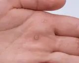 Dłoń mężczyzny z kilkoma brodawkami, które mogą być objawem wirusa HPV. Widoczne zmiany skórne na wewnętrznej stronie dłoni.